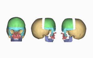 Craniofacial Surgery