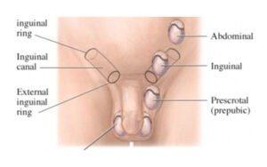 Cryptorchidism