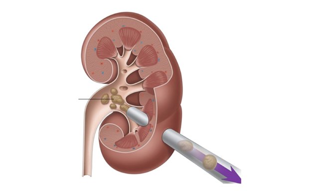 Kidney Stones