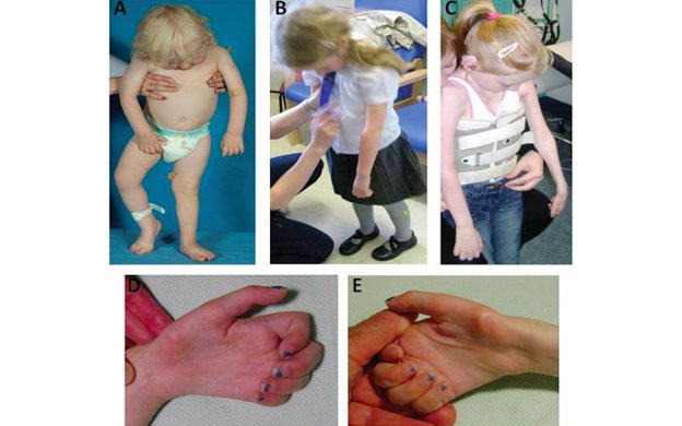 Spinal Muscular Atrophy