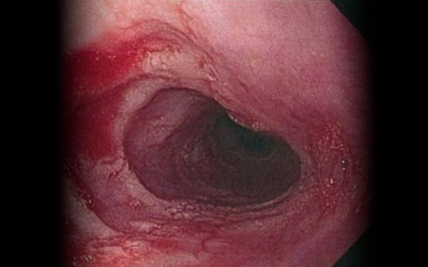 Eosinophilic esophagitis: Translational approaches to diagnostic and therapeutic challenges