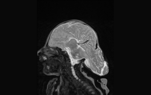 Fetal Encephalocele