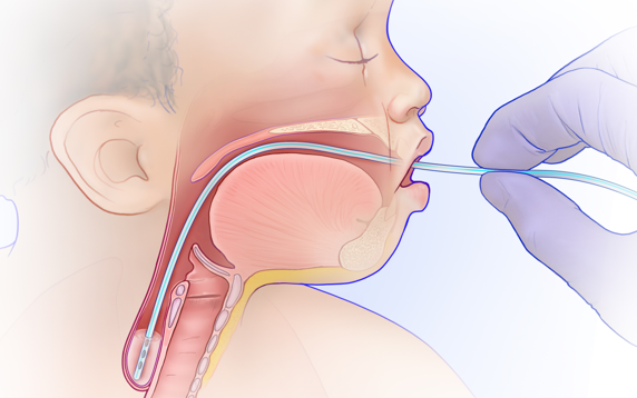 Congenital Tracheoesophageal Anomalies