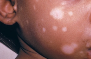 Pediatric skin of color