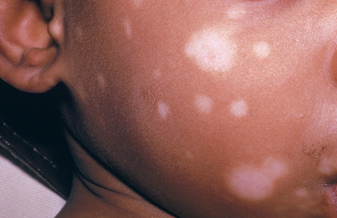 Pediatric skin of color
