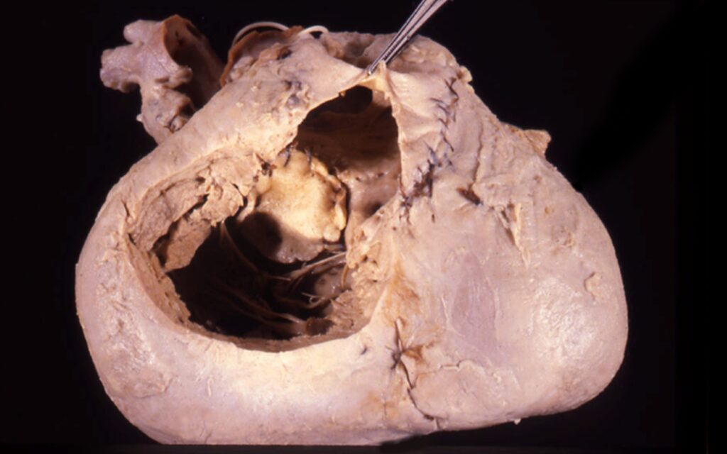 Tetralogy of Fallot: A 350-Year Journey