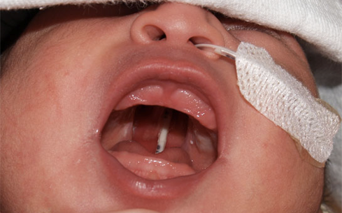 22q Part II: Prenatal Diagnosis, Classic Fetal Findings and Pregnancy Management