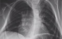 Respiratory Complications of Neuromuscular Disease