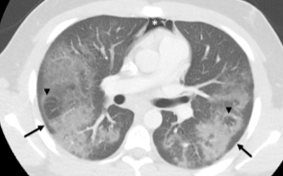 Lung Injury Disorders