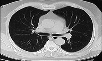 Cystic Fibrosis: Pathophysiology and Respiratory Manifestations