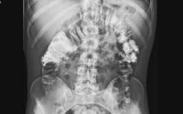 Non-Pulmonary Manifestations of Cystic Fibrosis