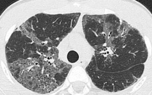 Interstitial Lung Diseases