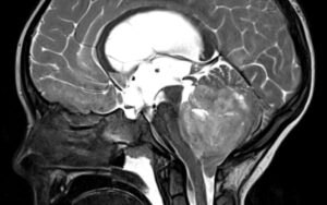 Management of the Infant/Young Child with Medulloblastoma