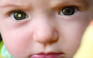 Pediatric Cancer Predisposition Syndromes