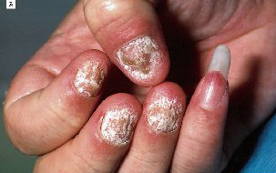 Autoimmune Liver Disease and Primary Sclerosing Cholangitis