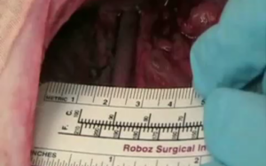 Gastrointestinal Bleeding Therapy