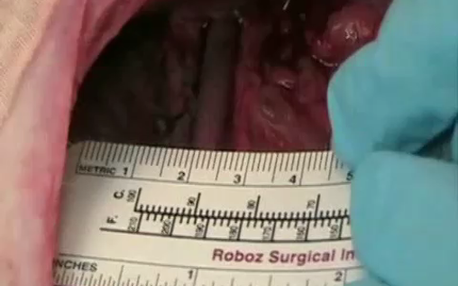 Gastrointestinal Bleeding Therapy