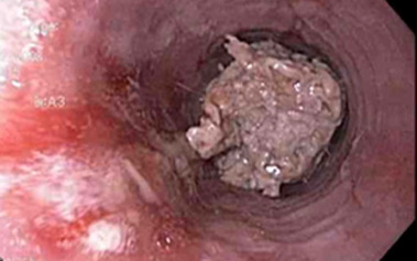 Eosinophilic Esophagitis