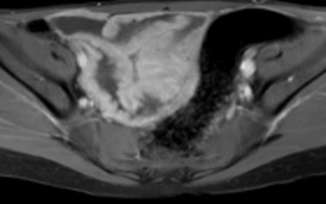 Pediatric Inflammatory Bowel Disease Etiology and Diagnostics