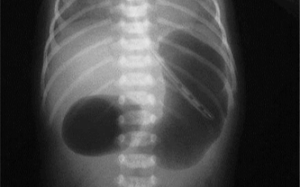 Surgical GI Emergencies