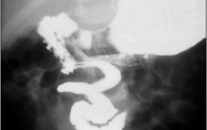 Dysphagia and GERD