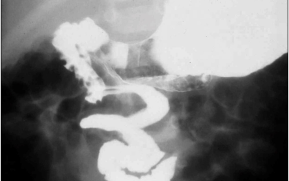 Dysphagia and GERD