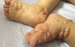 Cholestatic Liver Disease