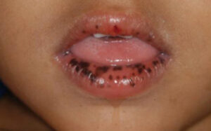 GI Polyps in Children