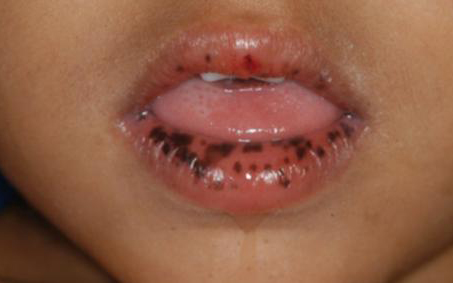 GI Polyps in Children