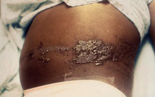 Vaccine Preventable Diseases: Making a Comeback